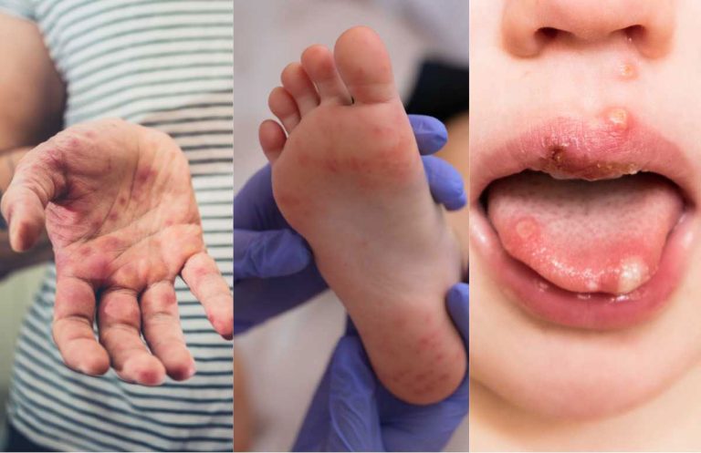 Hand__Foot_and_Mouth_Diseas